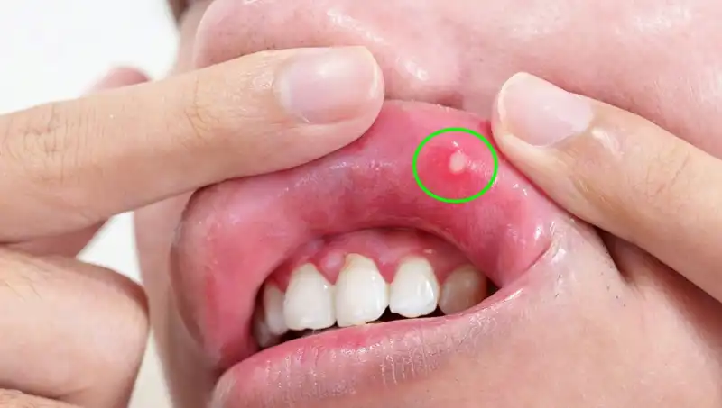 Vücutta B vitamini Eksikliği: Belirtiler Ve Tedavi Yöntemleri