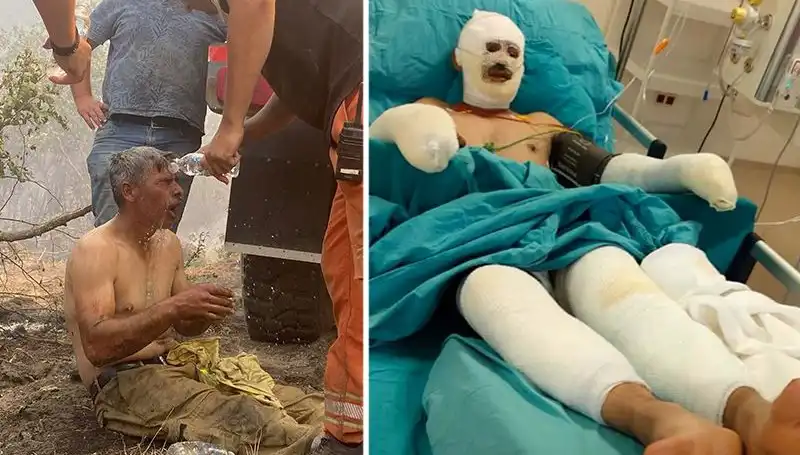 Yanıyorum Feryadı: Orman İşçisinin Tedavi Süreci Devam Ediyor